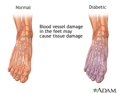 http://amgdoctors.adam.com/ Alasan mengapa perlu obat luka diabetes yang tepat