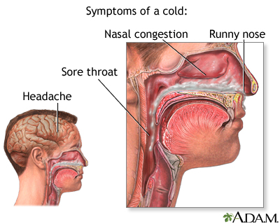 Will Post Nasal Drip Cause Sore Throat